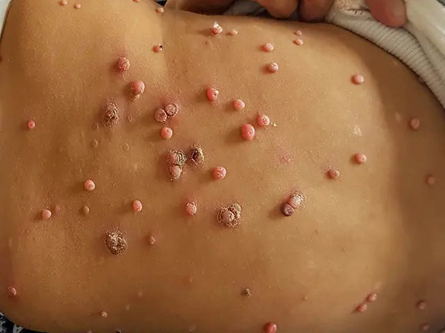 Molluscum contagiosum images