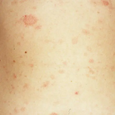 pityriasis rosea