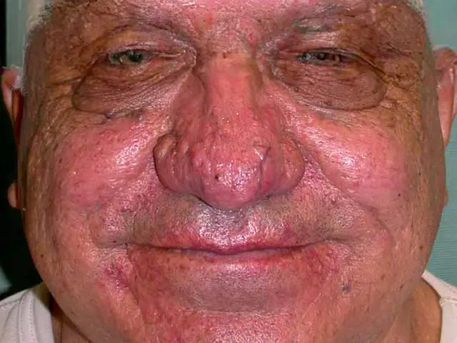 Rosacea 