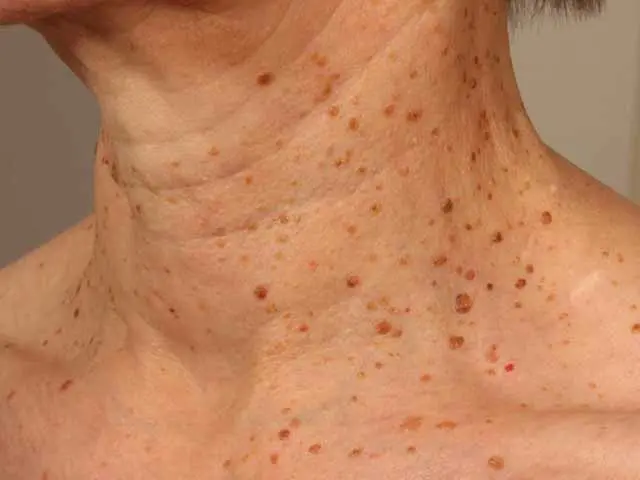 Seborrhoeic keratosis images