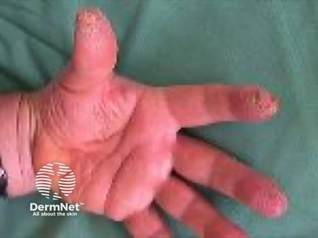 Contact allergic dermatitis of the hands