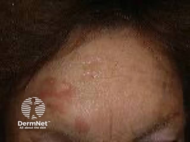 Actinic Keratoses affecting the face