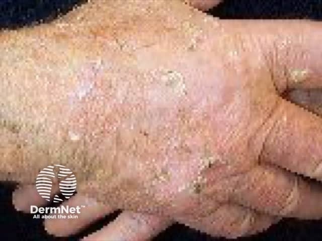 Actinic keratoses affecting the hands