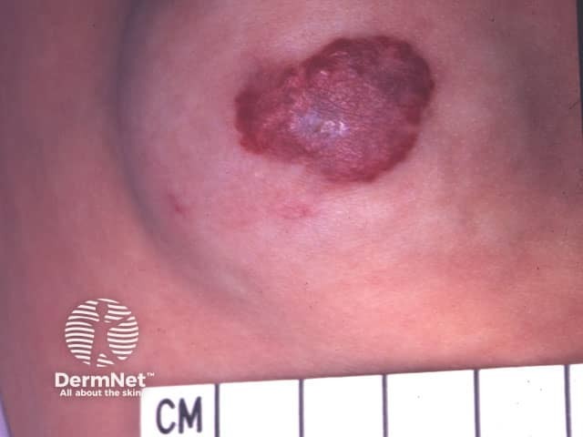 Mixed infantile haemangioma