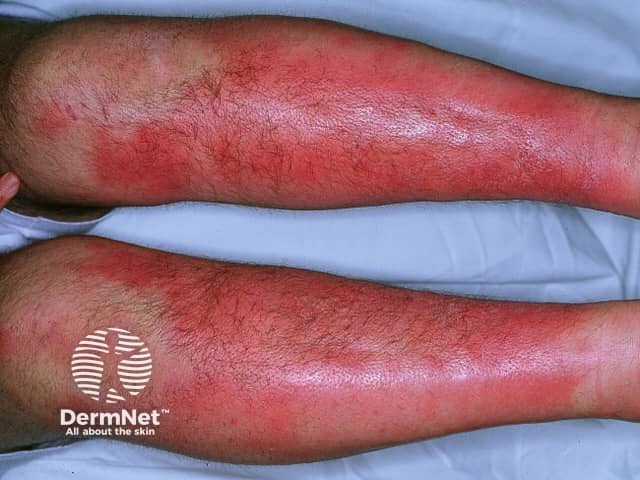 Erythema nodosum