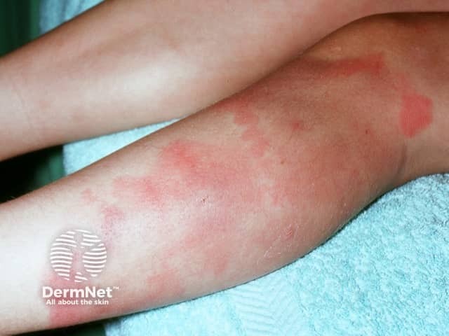 Erythema nodosum