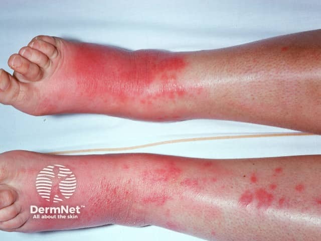 Erythema nodosum