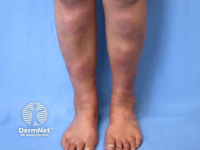 Erythema nodosum