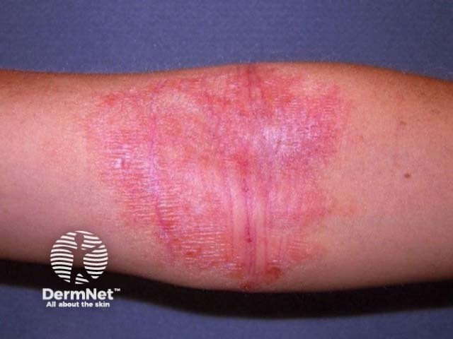 Antecubital fossa atopic eczema suitable for ruxolitinib cream