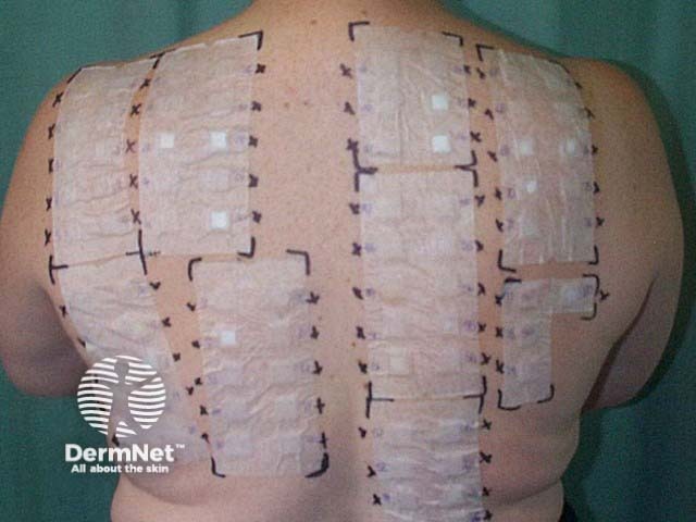 An extensive patch test series - the four panels on the left are the standard series